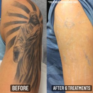 Laser Tattoo Removal With PicoSure | Lake Oswego Vein & Aesthetic