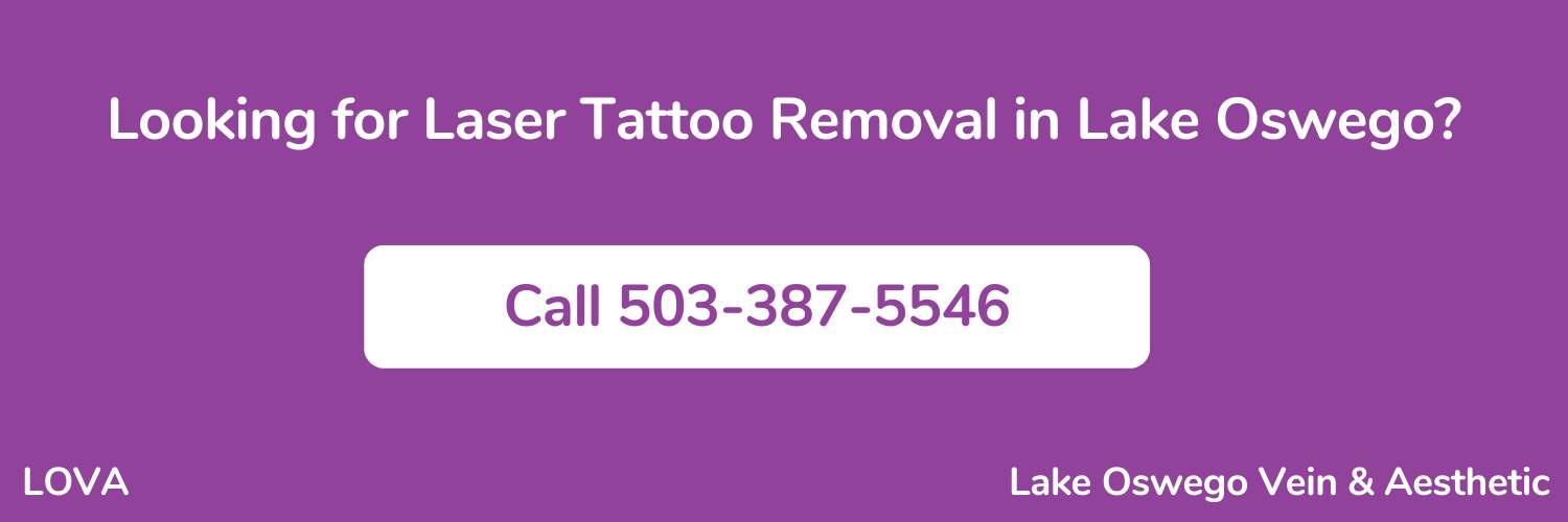 laser tattoo removal lake oswego