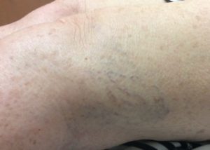 Sclerotherapy before photo